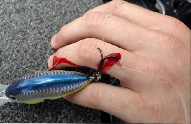 Longview angler Jim Tutt snapped this photo earlier this summer after his 13-year-old nephew, Andrew, accidentally impaled himself with a crank-bait treble hook. Tutt used the “string-yank” technique to remove the hook in a matter of seconds. Courtesy/Jim Tutt via Matt Williams